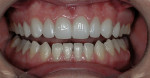 Figure 8  Postoperative view of no-preparation veneers on teeth Nos. 5 through 12. Note the subtle axial rotation difference of tooth No. 9 in comparison to tooth No. 8 that is often found in nature’s blueprint.