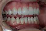 Figure 9  A 1:2 retracted right-side view of no-preparation veneers showing pleasing contours despite no tooth reduction.