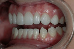 Figure 10  A 1:2 retracted left-side view of no-preparation veneers—note the natural warmth in color of the cuspid created by shine-through of the underlying natural tooth.