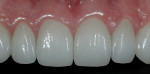 Figure 11  A 1:1 view of no-preparation veneers demonstrating excellent tissue health and undetectable margins.