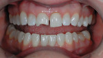 Figure 12  A 1:2 retracted preoperative view immediately after removing old composite from tooth No. 8 and leveling tissue with a diode laser.