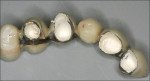 Figure 7  Cantilever TISP (teeth Nos. 8 and 9, No. 10 is a pontic,Nos. 11 and 12 are implants, and No. 13 is a cantilever) withintact interim cement seal at 3 months.