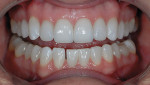 Figure 13  A 1:2 retracted postoperative view of e.max no-preparation veneers on teeth No. 5 through 12. Note how nicely the ceramic filters the missing on the incisal edge of tooth No. 8.