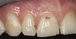 Figure 1  The patient presented with interproximal and cervical decay after orthodontic treatment.