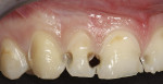 Figure 2  The completed preparations. Areas of affected decalcified enamel remained.