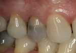 Figure 1  Preoperative buccal view of a nonrestorable upper left first bicuspid (tooth No. 5).