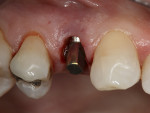 Figure 5  A 4-mm Solid Abutment was placed, hand-tightened, and temporized at the time of surgery.