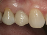 Figure 6  The case was finalized after 10 weeks of uneventful healing. The abutment was torqued to 35 Ncm, and the PFM crown was permanently cemented.
