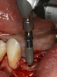 Figure 9  Insertion of the Straumann Roxolid Bone Level Narrow Connection implant. The fixture of choice was the SLActive Roxolid implant, to replace four teeth with two narrow-diameter implants.