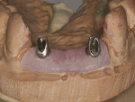 Figure 11  Custom-milled Straumann CARES abutments were used to develop a hygienic emergence profile.