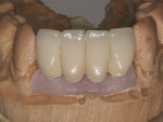 Figure 12  The final PFM bridge fabricated after tissue maturation.