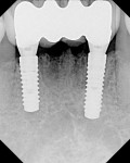 Figure 14  Radiographic view of the implants and final prosthesis.