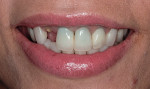 Full smile photograph of patient with dislodged post-retained crown on tooth No. 7.