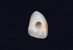 The metal post was removed from the crown, and an access opening was made on the palatal aspect.