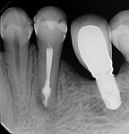 Three-month follow-up radiograph demonstrating apical healing.