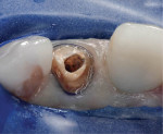 The thoroughly cleaned canal and tooth structure.
