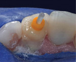 Dual-cure cement was used in the root canal and restorative composite in the crown.