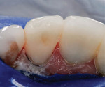 Removal of the excess post and restorative composite.