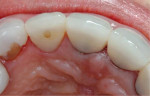 Palatal view after occlusal adjustments.