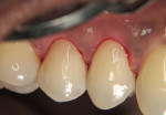 Figure 7   Simplifying Class 5 techniques with one to three layering applications of A3 F03 to create lifelike restorations.