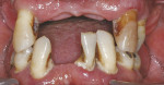 Figure 1  The patient presented with advanced periodontitis, pain, and 2+ mobility for all teeth.