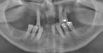 Figure 2  Moderate to severe bone loss was evident in the initial panoramic radiograph.