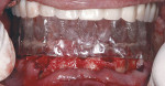 Figure 3  Try-in of the mandibular surgical guide, which was fabricated from the mandibular immediate denture.