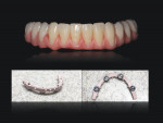 Fig 5. A wax try-in for a hybrid restoration is accompanied by the titanium, gingival-opaqued substructure that sits within it; the substructure uses a wrap-around design.
