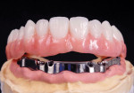 Fig 6. An implant bar with attachments is used for a removable overdenture. (Photo courtesy of Jong Y. Park, CDT, Uni Dental Studio, Inc.)