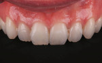 Fig 2. The patient presents as unhappy with the esthetics of her upper front teeth, as seen in the preoperative smile photograph and retracted maxillary view.