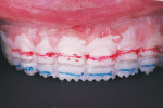 Fig 3. Bis-acryl transfer with depth cuts and graphite markings are made for the unprepared teeth.