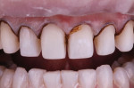 Fig 7. The retracted view of maxillary preparations shows final interproximal reduction after removal of decalcified enamel.