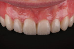 Fig 8. Retracted view of the approved provisional restorations is used for laboratory communication of the tooth contour for the final restorations.