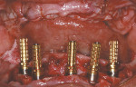 Figure 7  Low Profile Abutment Non-Hexed Temporary Cylinders in place on the abutments.