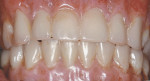 Figure 9  The immediate maxillary complete denture and mandibular fixed-provisional prosthesis, delivered immediately after mandibular implant placement.
