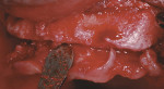Figure 11  On the day of maxillary implant placement, a full-thickness flap with a vestibular incision was reflected.