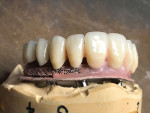 Fig 6. The wax-up is finalized prior to flasking.