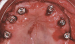 Figure 12  Straight-collar One-Piece Low Profile Abutments were placed into the six newly placed implants.