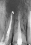 Fig 2. Periapical radiograph of the area of
concern, pretreatment.