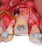 Fig 7. Step-by-step photographic documentation of the osteotomized segment with mesial and distal subapical cutting and chisel insertion to dislodge the block. Piezoelectric incision on distal side of tooth No. 8.