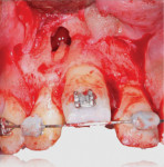 Fig 6. Step-by-step photographic documentation of the osteotomized segment with mesial and distal subapical cutting and chisel insertion to dislodge the block. After flap reflection, note periapical abscess on tooth No. 7.