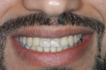Fig 12. Clinical situation post-orthodontic treatment and prior to prosthetic rehabilitation, retracted view (Fig 11) and patient’s smile (Fig 12).