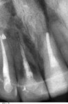 Fig 15. 24-month radiograph of tooth No. 8. Note the resolution of the periapical abscess on tooth No. 7 and the advancement of the internal resorption on tooth No. 8.