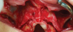Fig 3. Reflected maxillae.