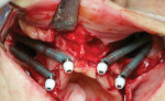 Fig 4. Quad zygomatic implant placement.