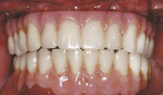 Figure 14  After placement of the maxillary implants, the patient left the surgical office with the maxillary and mandibular fixed-provisional prostheses in place.