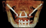 Fig 15. Three-year post-treatment CBCT scan, facial view.