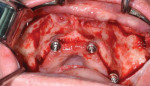 Fig 12. Reflected maxillae prior to zygomatic implant placement.