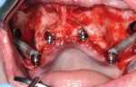 Fig 13. Zygomatic implants and additional implants placed in premaxillary region.