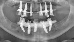 Figure 15  Radiograph taken on the day of maxillary implant placement.